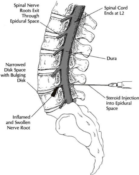 Epiduralni-anestezie